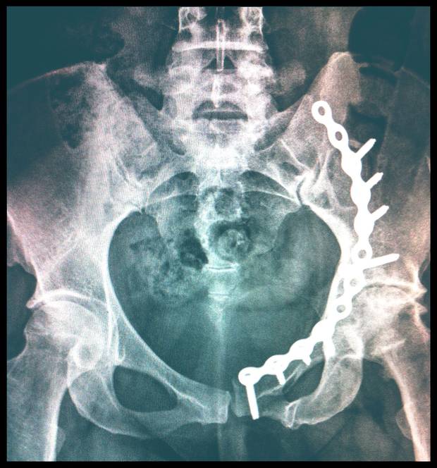 A car crash smashed archeologist Stacey Taylor’s hip beyond repair, but the physical recovery wasn’t her only obstacle: She was denied long-term benefits by the insurance company’s chosen doctor. ‘It would just make you cry because you knew that this was ridiculous and you were in a system that you couldn’t beat,’ Ms. Taylor says. ‘It is stacked against you.’