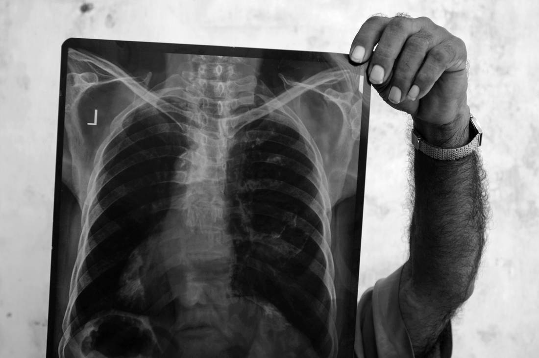Raghunath Manwar examines an x-ray of one of several workers who has been diagnosed with asbestosis in Ahmedabad, India. Raghunath is the secretary of an NGO called the Occupational Health and Safety Association and he is located in Ahmedabad in the western Indian state of Gujarat. He is working with the employees affected by asbestos from the Ahmedabad Electric Company (AEC) and the former Digvijay Cement Factory.