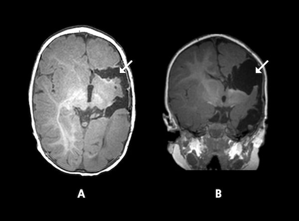 MRIs for a 2½ month old patient where top (A) and rear (B) views show minimal brain tissue removed during a functional hemispherectomy.